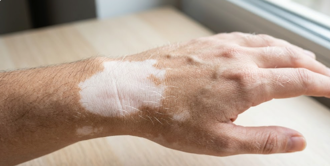 Vitiligo e Poliose: Quando o vitiligo afeta a cor dos cabelos e pelos do corpo.