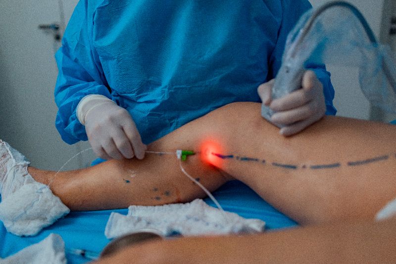 Como Acabar com as Varizes: 7 Tratamentos Médicos Comprovados